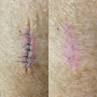 Before and after using emu oil to help heal surgical wound