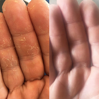 Before and after hand dermatitis